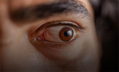 Enfermedad Ocular Tiroidea